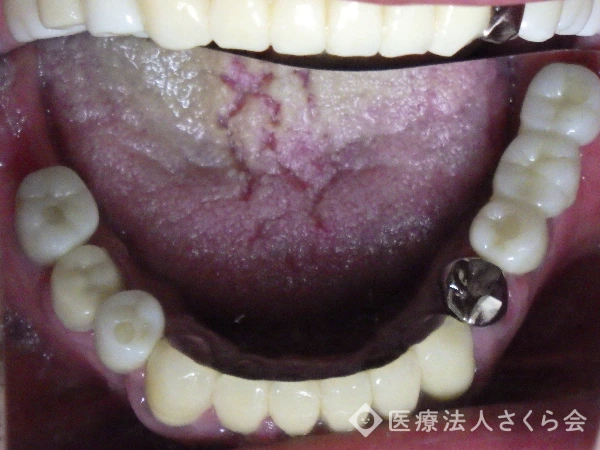 インプラント治療後