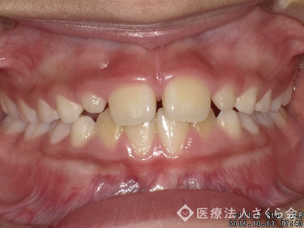 小児矯正治療後