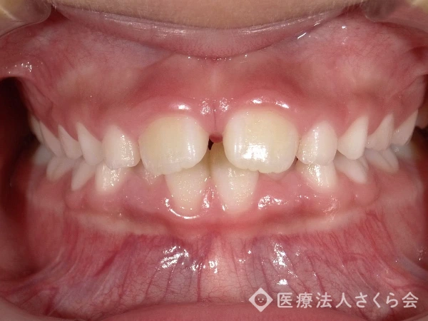 小児矯正治療前