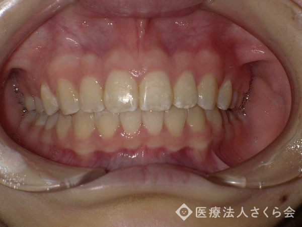 ワイヤー矯正治療後