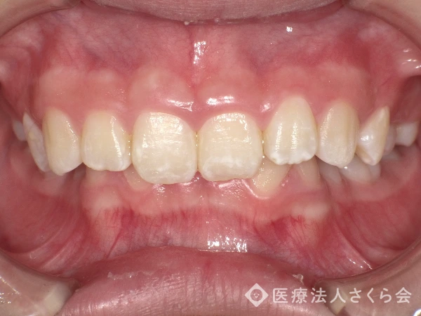 ワイヤー矯正治療前