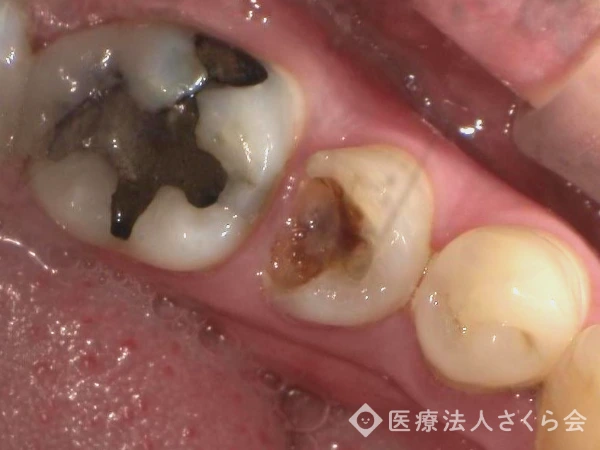 セラミック治療前